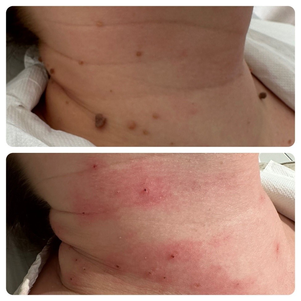 novemed-zabiegi-oferta-plasma-iq-przed-po-01